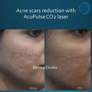 Acne scar Reduction