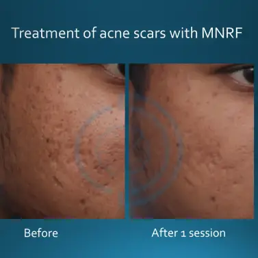 Acne scar Result