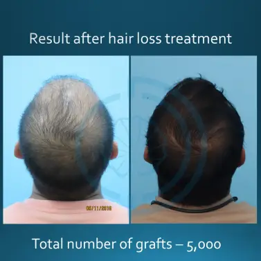 Before & after for hair Transplant