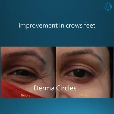 crows feet treatment