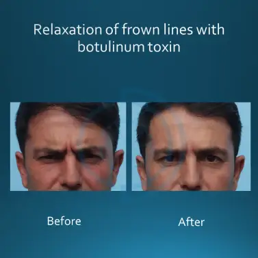 frown lines removal 