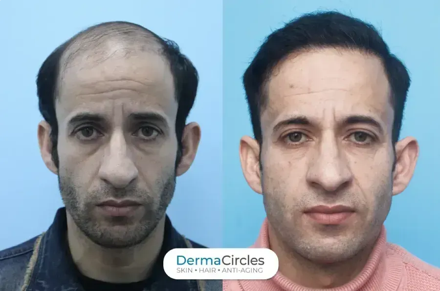 Hair Tranplant Result