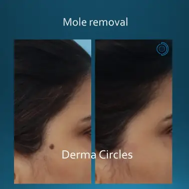 Mole removal result