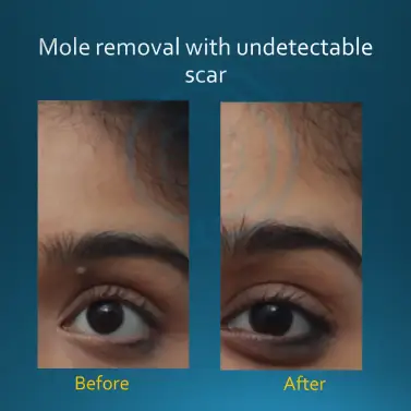 mole removal treatment