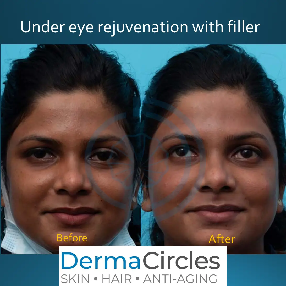 under eye filler treatment